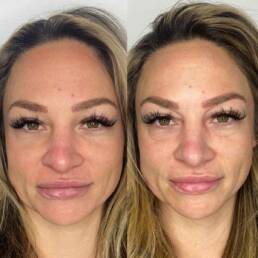 NaturaPeel Facial | Before and after Treatment Images