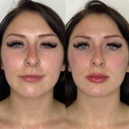 Cheek & Lip Fillers | Before and After Treatment Images
