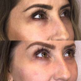Cheek and undereye fillers at Beauty Refined