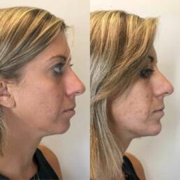 Chin and Lower Face Filler Before & After Treatment Images in Denver Tech Center, & Parker Colorado