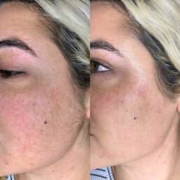 Dermaplane Before and After Treatment Images | Denver Tech Center, & Parker Colorado
