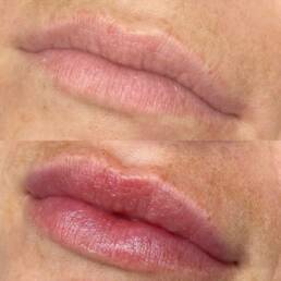 Lip Filler Before & After Treatment Images | Beauty Refined