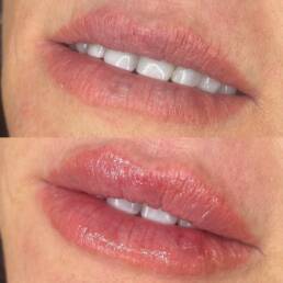 Before and After Lip Fillers | Beauty Refined