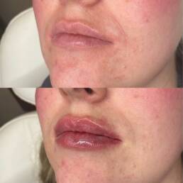 Lip Fillers Before and After Treatment Images | Beauty Refined