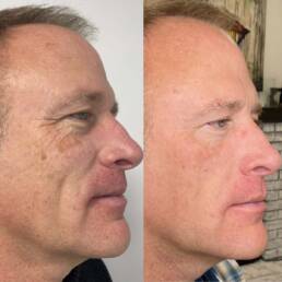 Chrome Laser Face Treatment | Before and after Treatment Images