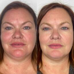 Beauty Refined | Before and after Treatment Images
