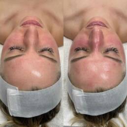 Skinwave before and after Treatment images in Beauty Refined