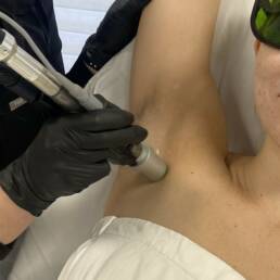 Chrome Laser Hair Removal by Beauty Refined