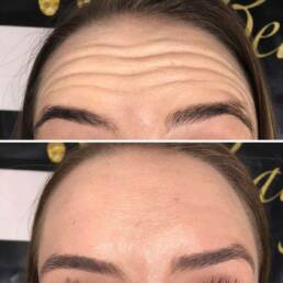 Neurotoxin 1 Forehead Lines | Beauty Refined in Denver Tech Center, & Parker Colorado