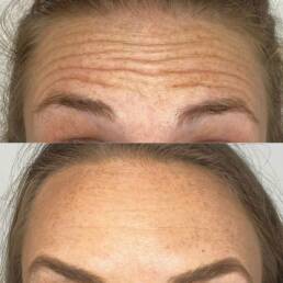 Neurotoxin 3 Forehead Lines | Beauty Refined in Denver Tech Center, & Parker Colorado
