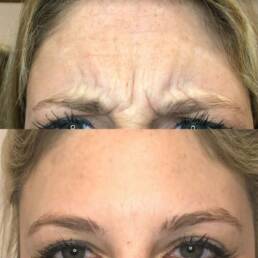 Neurotoxin 4 Frown Lines | Beauty Refined in Denver Tech Center, & Parker Colorado