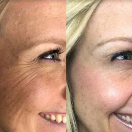 Neurotoxin Treatments | Beauty Refined in Denver Tech Center, & Parker Colorado