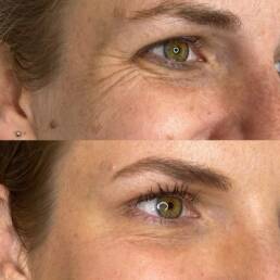 Neurotoxin Treatments | Beauty Refined in Denver Tech Center, & Parker Colorado