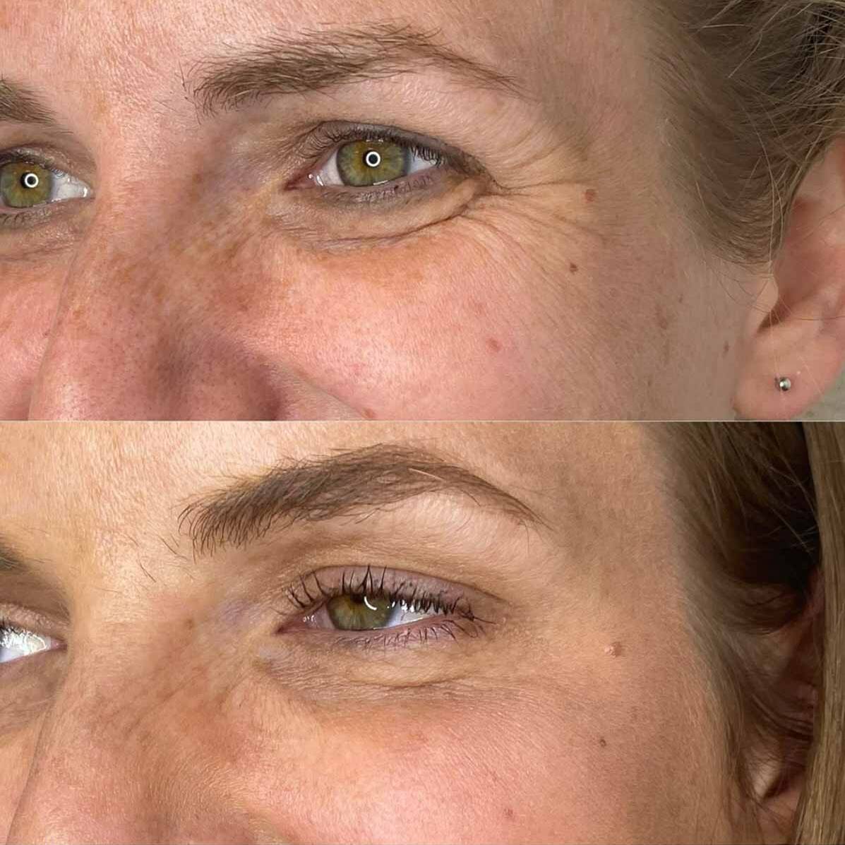 Neurotoxin Treatments | Beauty Refined in Denver Tech Center, & Parker Colorado