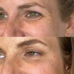 Neurotoxin Treatments | Beauty Refined in Denver Tech Center, & Parker Colorado