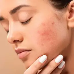 Breakouts Facial for Acne Scars in Greenwood Village, CO by Beauty Refined