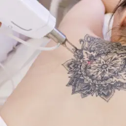 A woman receiving laser treatment on a large black tattoo on her upper back, illustrating Laser Tattoo Removal in Greenwood Village, CO.